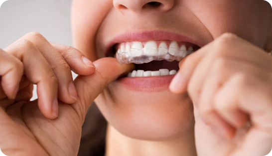 Close-up of patient inserting Invisalign Aligner, highlighting the convenience of removable teeth straightening.