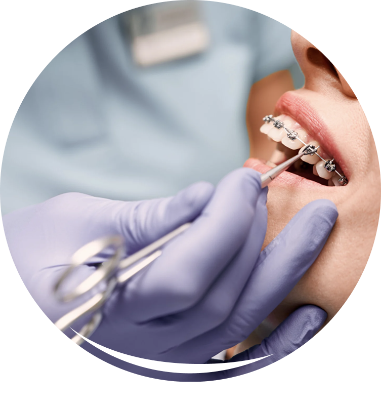 Traditional metal braces on teeth model for affordable teeth straightening options in Nallagandla.