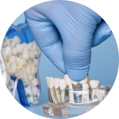 Hand in blue glove placing a crown on a dental model, demonstrating implant planning and restoration.