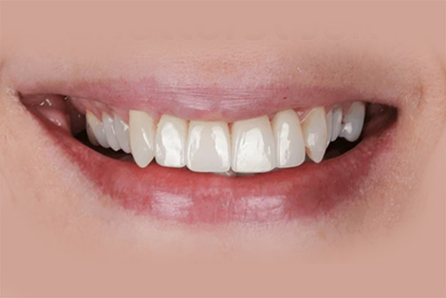 after-aligners