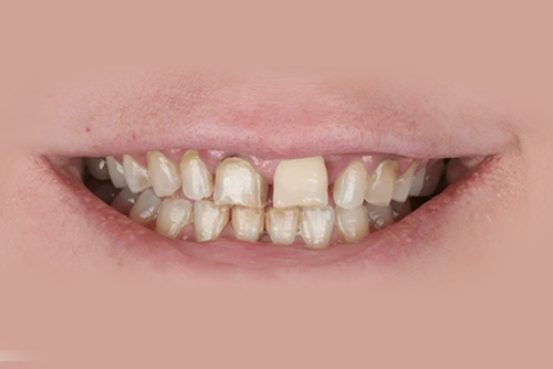 before-aligners-teeth