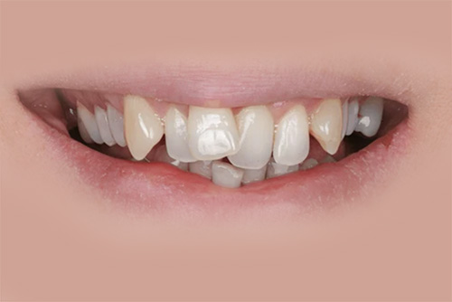 before-aligners