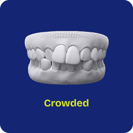 Crowded teeth before and after Invisalign treatment at International Dental Care Hyderabad – real patient result