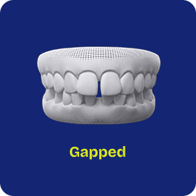 Gapped teeth (diastema) closed with Invisalign at International Dental Care Hyderabad